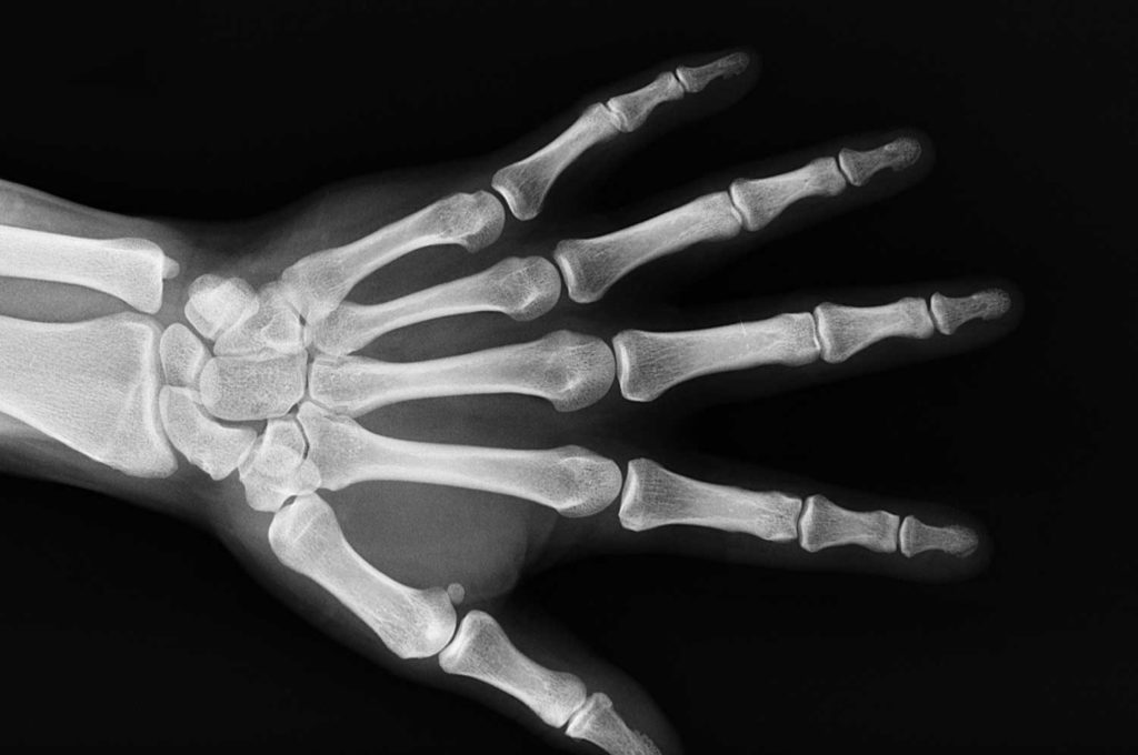 Osteoporose: Oft erst spät erkannt